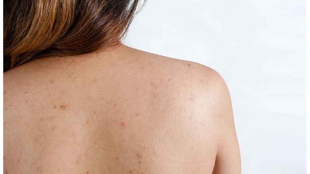 Viêm nang lông là tình trạng vi khuẩn hoặc nấm tấn công và viêm nhiễm ở da